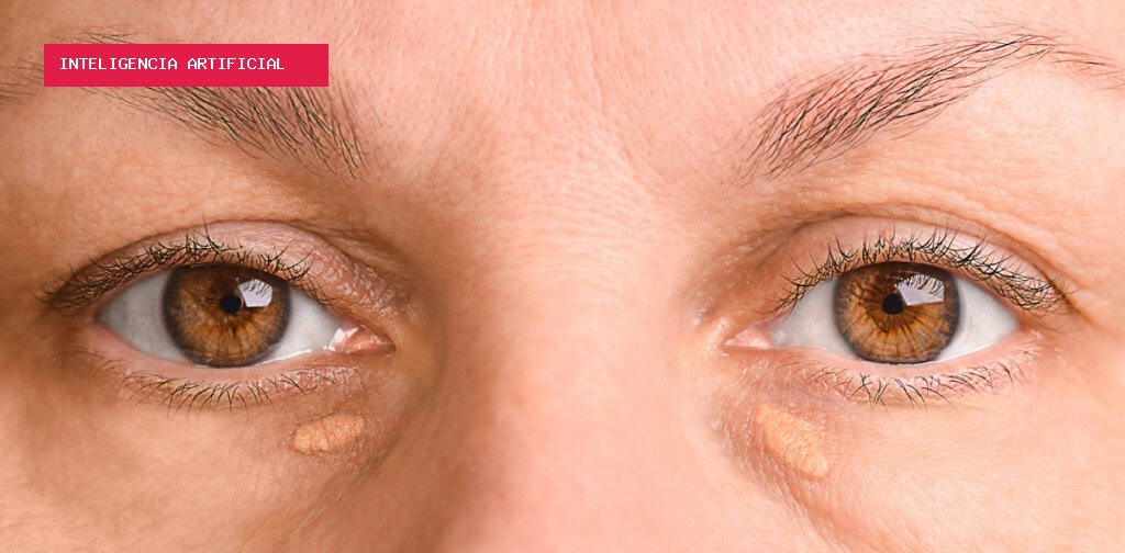 Manchas ao redor dos olhos acendem alerta de risco de infarto e derrame